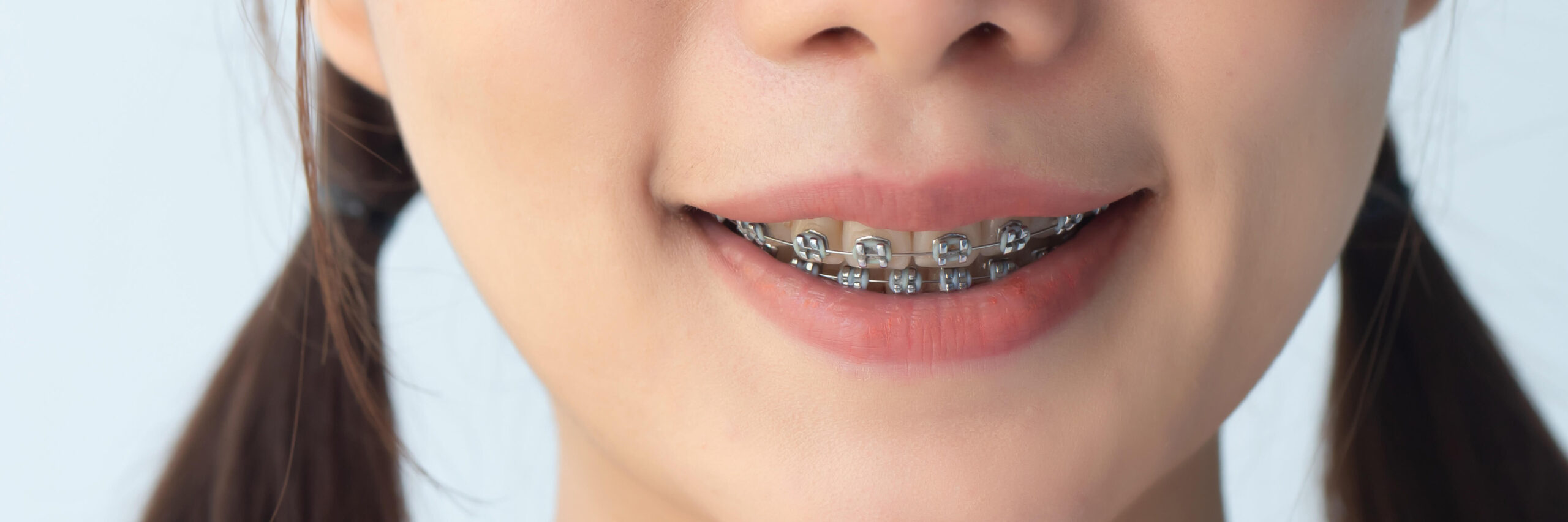 Getting Ready for Your Child’s Orthodontic Journey 