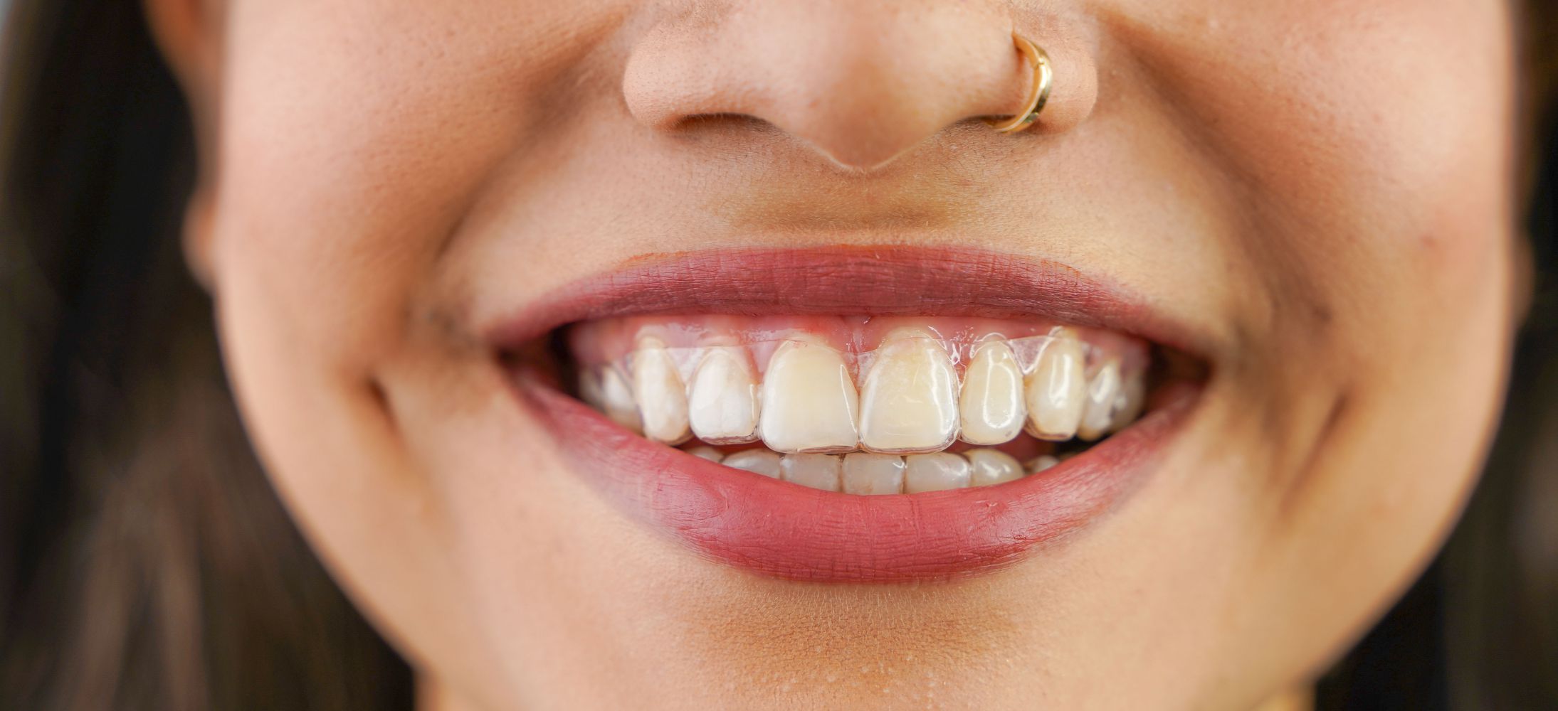 Benefits of Clear Aligners in Peoria, AZ