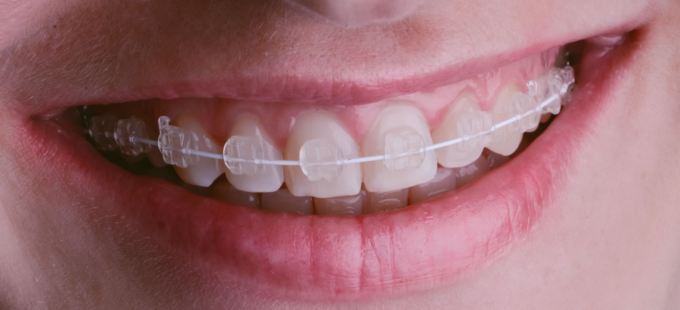 Patient smiling with braces in Peoria, AZ